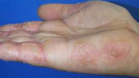 Atopic Dermatitis (AD)