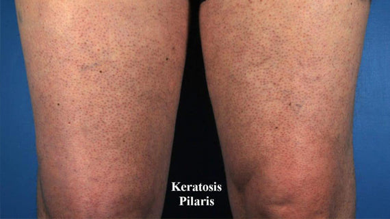 Keratosis Pilaris