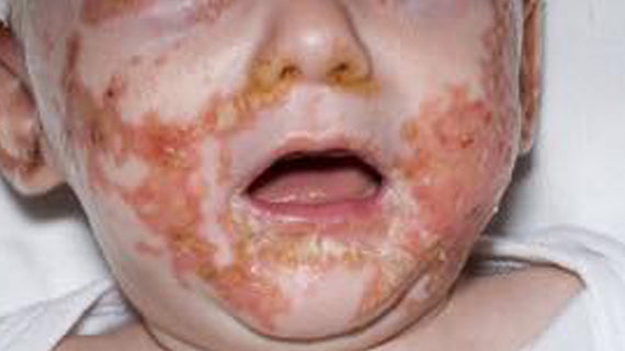 Acrodermatitis Enteropathica (AE)